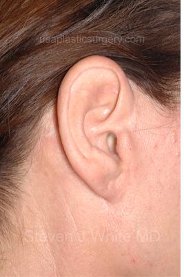 Facelift - Scar Before & After Patient #8221