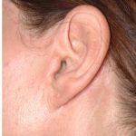 Facelift - Scar Before & After Patient #8221