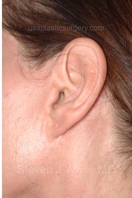 Facelift - Scar Before & After Patient #8221
