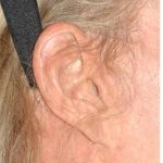 Facelift - Scar Before & After Patient #8222