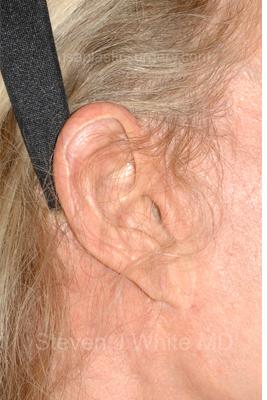 Facelift - Scar Before & After Patient #8222