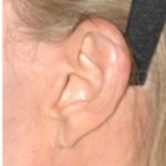 Facelift - Scar Before & After Patient #8222