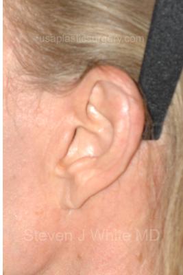 Facelift - Scar Before & After Patient #8222