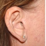 Facelift - Scar Before & After Patient #8223