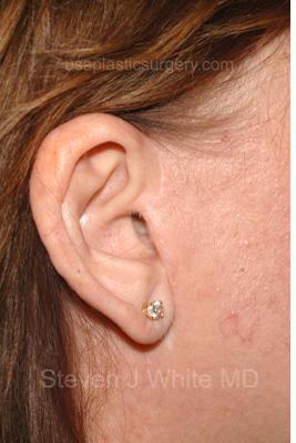 Facelift - Scar Before & After Patient #8223