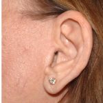 Facelift - Scar Before & After Patient #8223