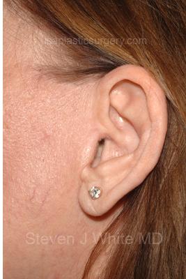 Facelift - Scar Before & After Patient #8223
