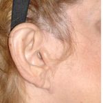 Facelift - Scar Before & After Patient #8224