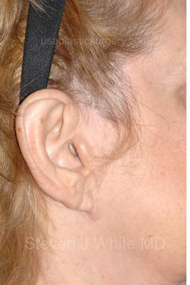 Facelift - Scar Before & After Patient #8224