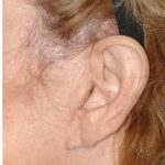 Facelift - Scar Before & After Patient #8224