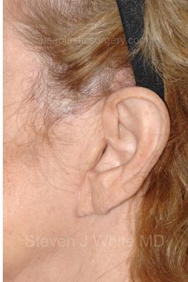 Facelift - Scar Before & After Patient #8224