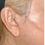 Facelift - Scar Before & After Patient #8225