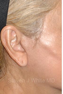 Facelift - Scar Before & After Patient #8225