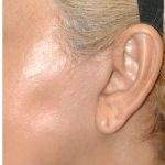 Facelift - Scar Before & After Patient #8225