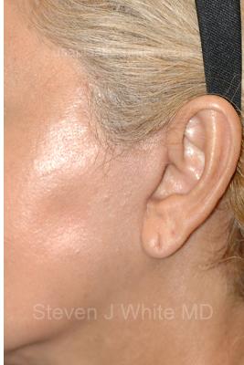 Facelift - Scar Before & After Patient #8225