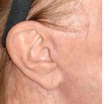 Facelift - Scar Before & After Patient #8226