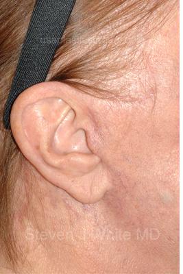 Facelift - Scar Before & After Patient #8226