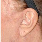 Facelift - Scar Before & After Patient #8226