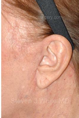 Facelift - Scar Before & After Patient #8226