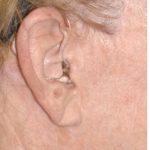 Facelift - Scar Before & After Patient #8227