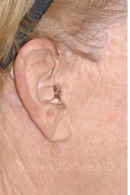 Facelift - Scar Before & After Patient #8227