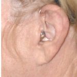 Facelift - Scar Before & After Patient #8227