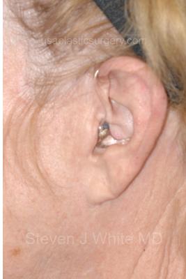 Facelift - Scar Before & After Patient #8227
