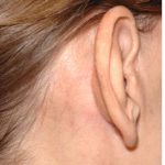 Facelift - Scar Before & After Patient #8167