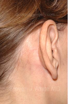 Facelift - Scar Before & After Patient #8167