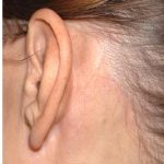 Facelift - Scar Before & After Patient #8167
