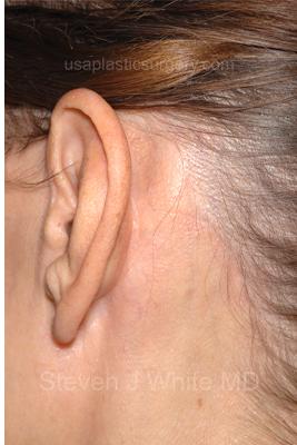 Facelift - Scar Before & After Patient #8167