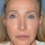 Upper & Lower Facelift - Brow Lift & Face/Neck Lift Before & After Patient #8027