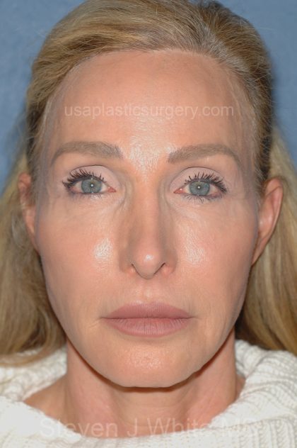 Upper & Lower Facelift - Brow Lift & Face/Neck Lift Before & After Patient #8027
