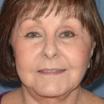Upper & Lower Facelift - Brow Lift & Face/Neck Lift Before & After Patient #8301