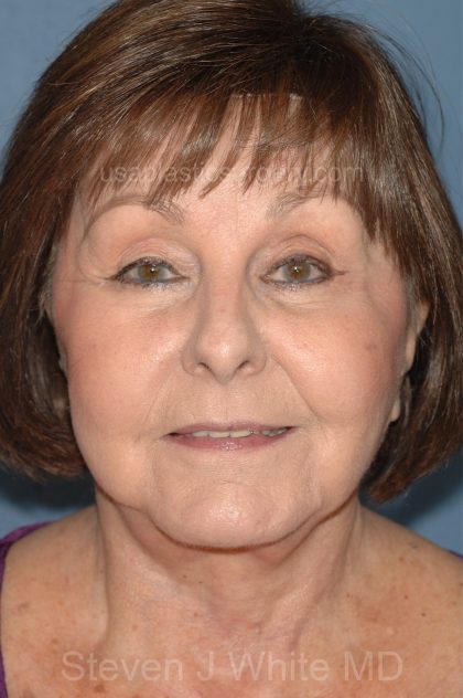 Upper & Lower Facelift - Brow Lift & Face/Neck Lift Before & After Patient #8301