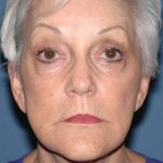 Upper & Lower Facelift - Brow Lift & Face/Neck Lift Before & After Patient #8302