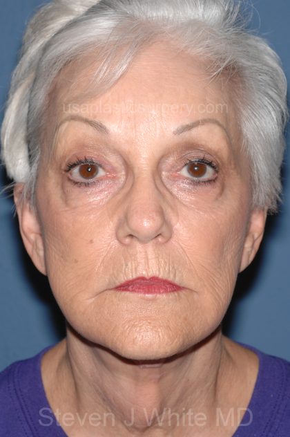 Upper & Lower Facelift - Brow Lift & Face/Neck Lift Before & After Patient #8302