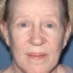 Upper & Lower Facelift - Brow Lift & Face/Neck Lift Before & After Patient #8303