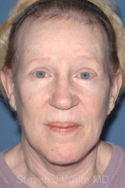 Upper & Lower Facelift - Brow Lift & Face/Neck Lift Before & After Patient #8303