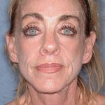 Upper & Lower Facelift - Brow Lift & Face/Neck Lift Before & After Patient #8304