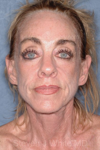 Upper & Lower Facelift - Brow Lift & Face/Neck Lift Before & After Patient #8304