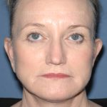 Upper & Lower Facelift - Brow Lift & Face/Neck Lift Before & After Patient #8305