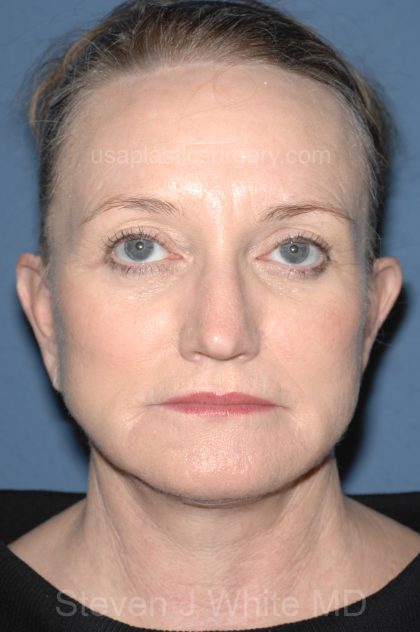 Upper & Lower Facelift - Brow Lift & Face/Neck Lift Before & After Patient #8305