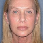 Upper & Lower Facelift - Brow Lift & Face/Neck Lift Before & After Patient #8026