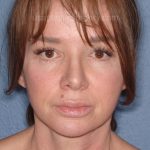 Upper & Lower Facelift - Brow Lift & Face/Neck Lift Before & After Patient #8028