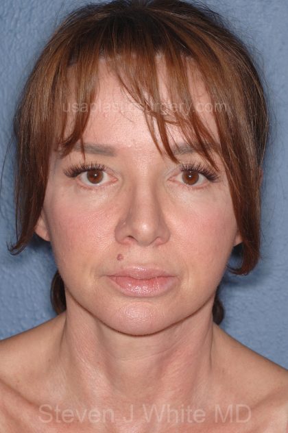 Upper & Lower Facelift - Brow Lift & Face/Neck Lift Before & After Patient #8028