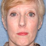 Upper & Lower Facelift - Brow Lift & Face/Neck Lift Before & After Patient #8029