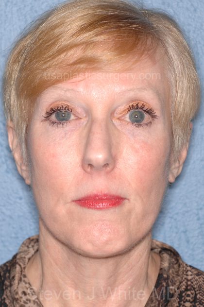 Upper & Lower Facelift - Brow Lift & Face/Neck Lift Before & After Patient #8029