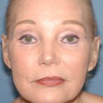 Upper & Lower Facelift - Brow Lift & Face/Neck Lift Before & After Patient #8030