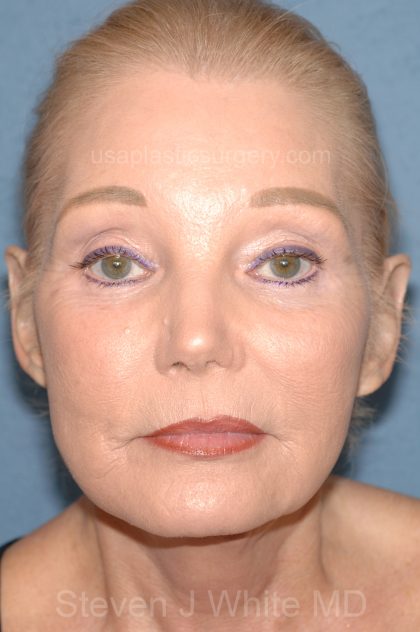 Upper & Lower Facelift - Brow Lift & Face/Neck Lift Before & After Patient #8030